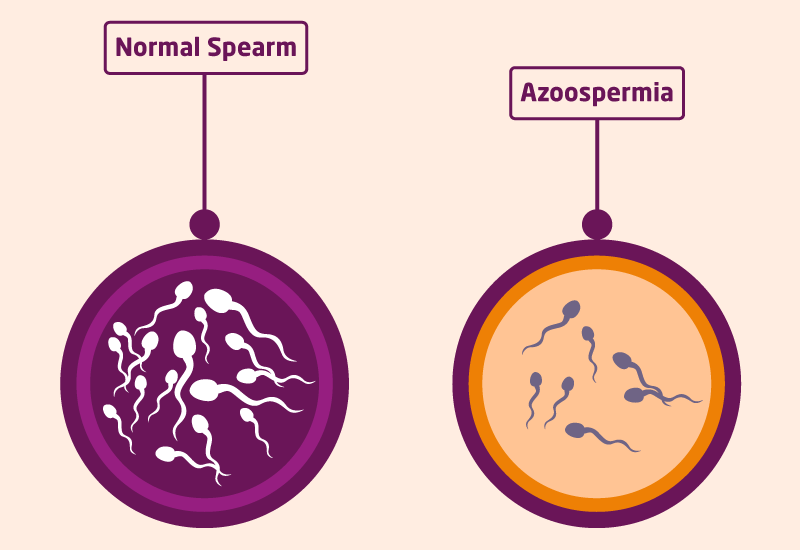 Can You Conceive Naturally with Azoospermia Ferticity IVF