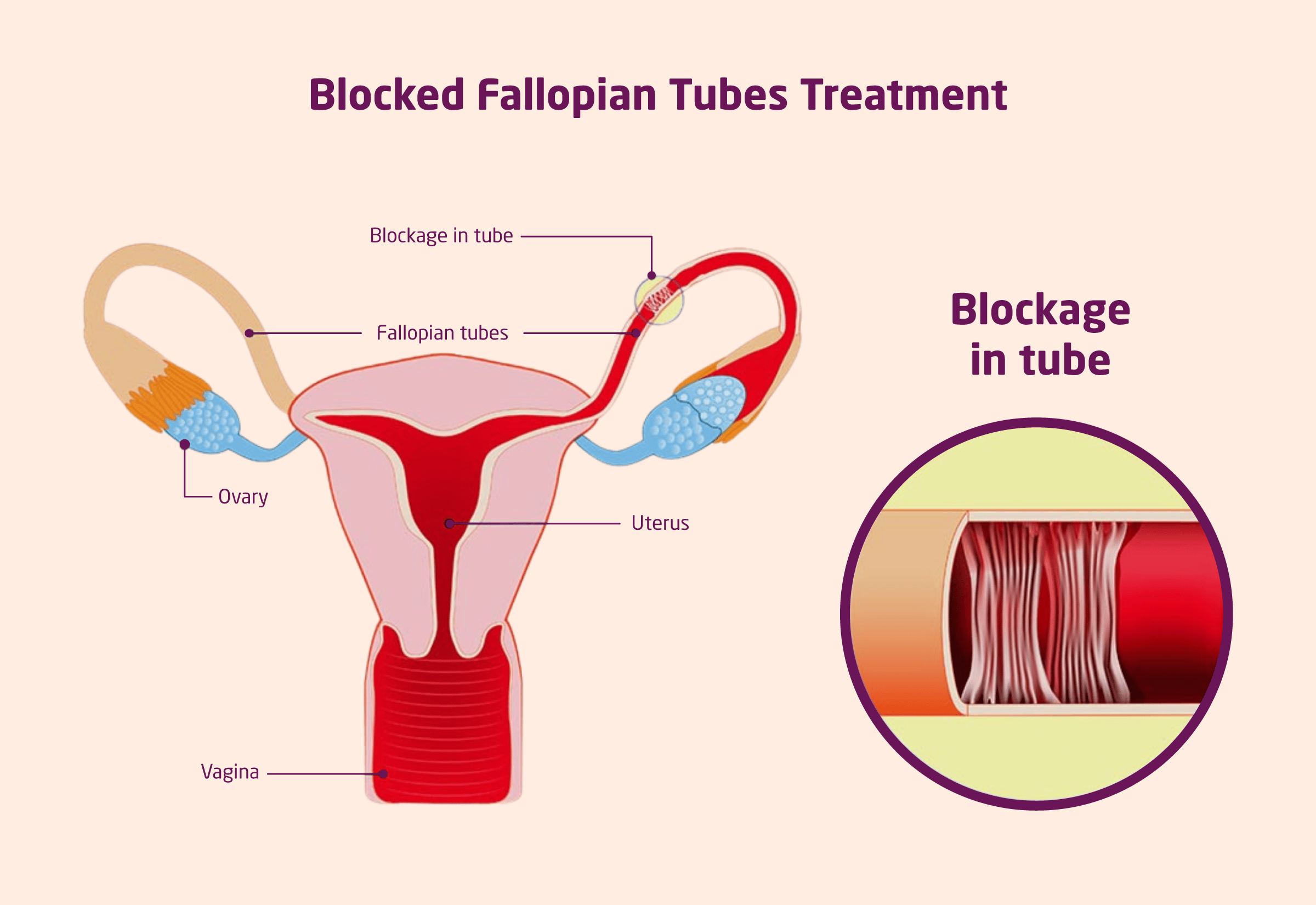 fallopian tube blockage