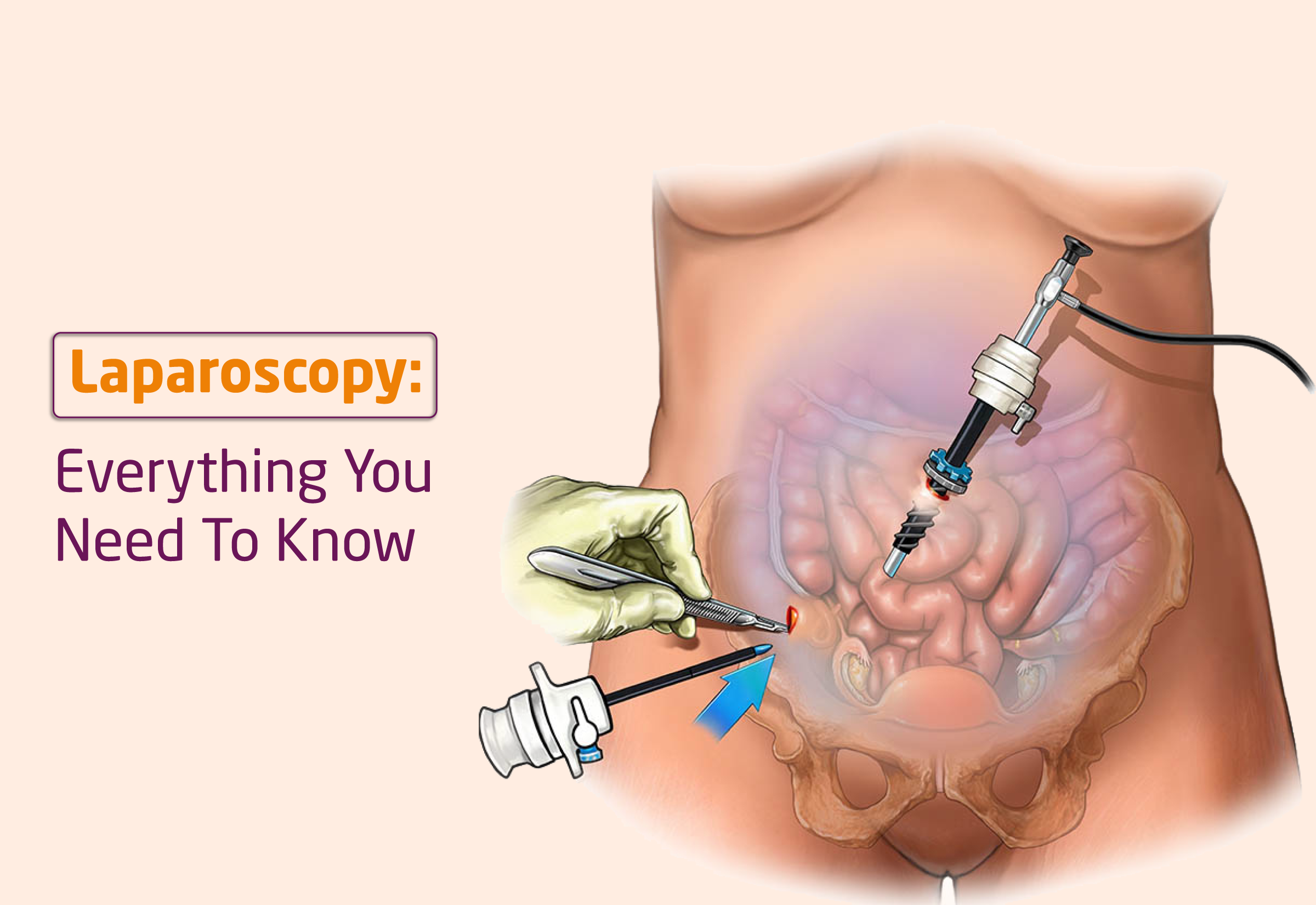 Laparoscopy: Everything You Need To Know