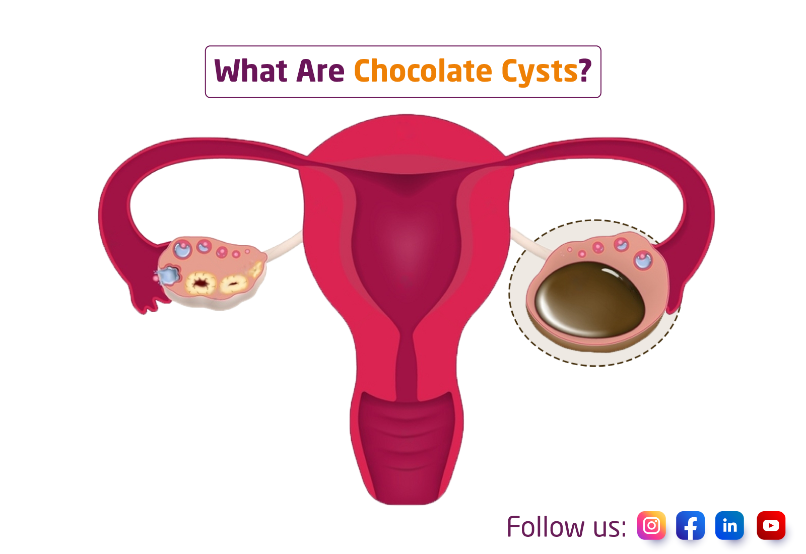 Ovarian Endometriomas: What Are Chocolate Cysts?