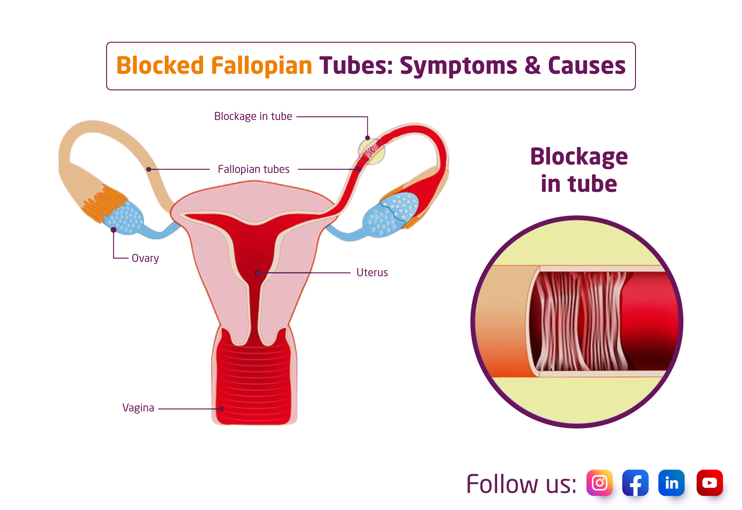 Hydrosalpinx (Blocked Fallopian Tube)