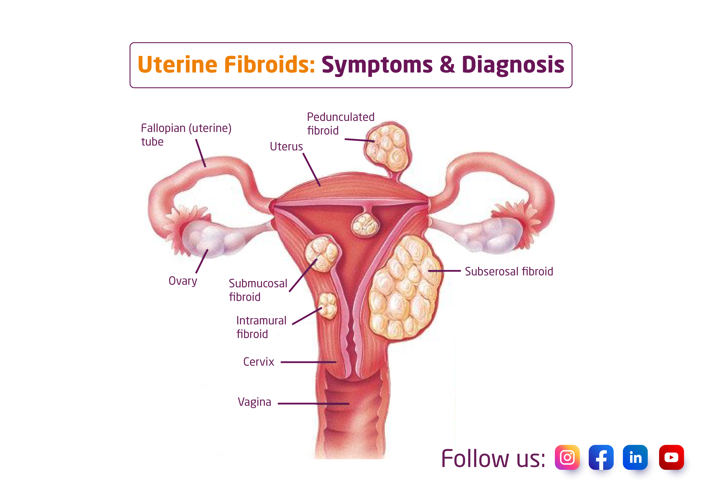 Uterine Fibroids: Symptoms & Diagnosis
