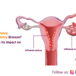What is Pelvic Inflammatory Disease? What are its impact on fertility