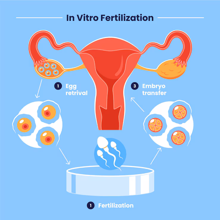 A vector showing IVF process steps from stimulation to transfer.