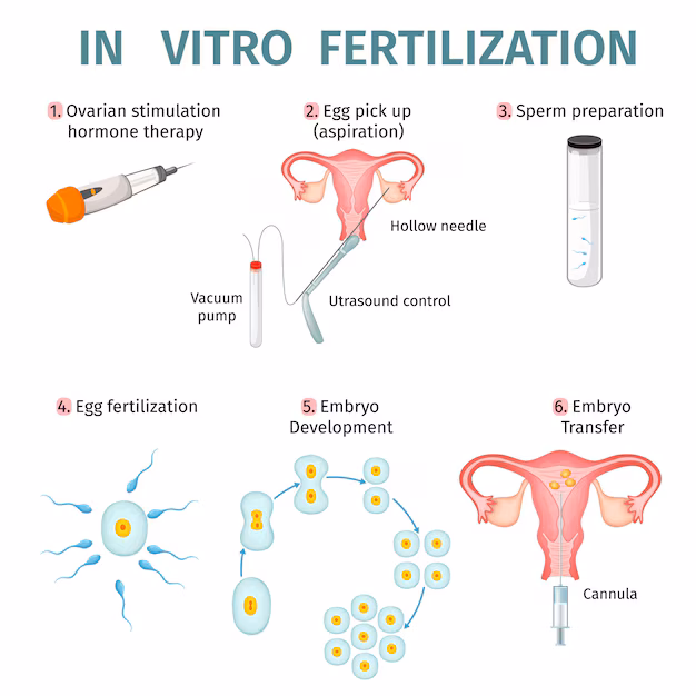 A chart showing the IVF procedure steps from egg retrieval to embryo transfer.
